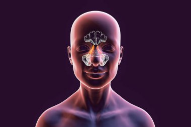 Parazal sinüslerin anatomisi. 3 boyutlu çizimler etmoid sinüsleri vurgulanmış bir kadını gösteriyor, ayrıca etmoid hava hücreleri olarak da bilinir.