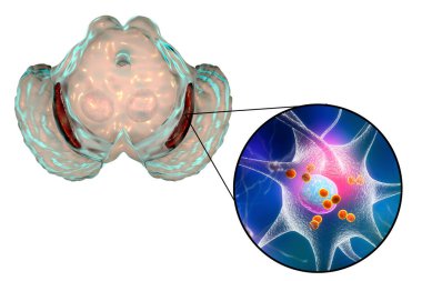 Siyah madde, orta beynin bazal bangliyonu, Parkinson hastalığında, 3 boyutlu illüstrasyon gösteriyor ki hacminde azalma var ve Levy 'nin bedenleri siyah maddenin pars compacta' sında nöronlara dahil.