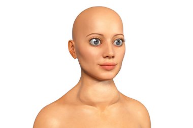 Hyperthyroidism. 3D illustration showing a female with Graves' disease, also known as toxic diffuse goiter, who has enlarged thyroid gland and exophthalmos clipart