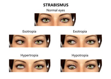Strabismus, 3 boyutlu illüstrasyon farklı göz sapmaları gösteriyor