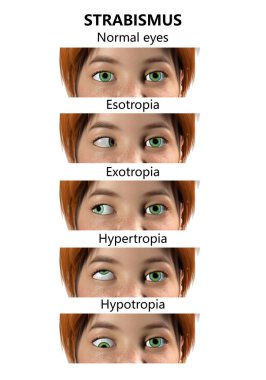 Çocuklarda strabismus, 3 boyutlu illüstrasyon farklı göz sapmaları gösteriyor