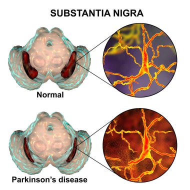 Substantia nigra in norm and in Parkinson's disease, 3D illustration showing decrease of its volume. There is degeneration of dopaminergic neurons in the pars compacta of the substantia nigra clipart