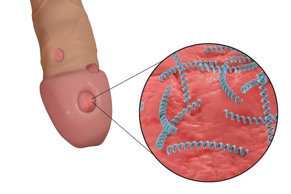 梅毒性潰瘍性潰瘍デュラムとクローズ アップ ビュー梅毒の細菌トレポネーマの イラストレーション ペニスの表面に — ストック写真