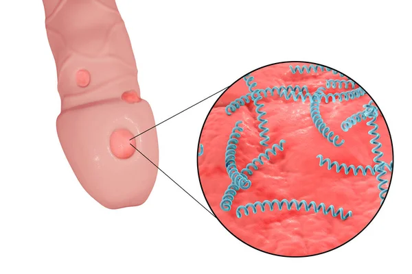 梅毒性潰瘍性潰瘍デュラムとクローズ アップ ビュー梅毒の細菌トレポネーマの イラストレーション ペニスの表面に — ストック写真