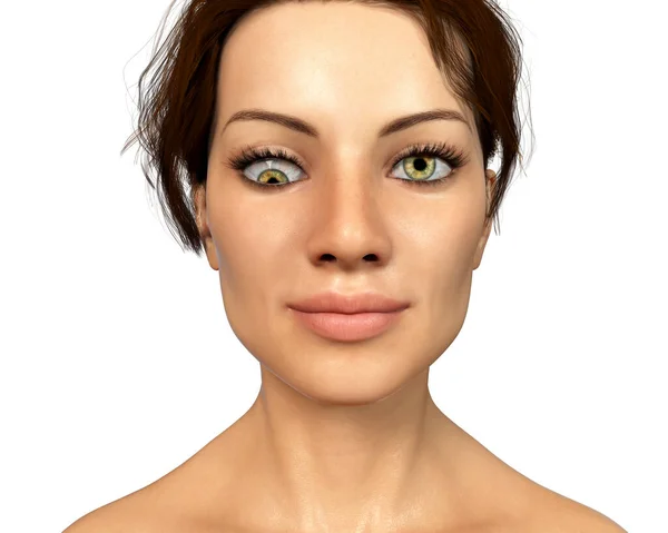 Strabismus Illustration Showing Hypotropia Type Eye Deviation Eye Turns Downward — 스톡 사진