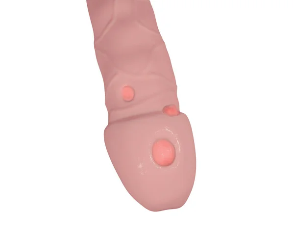 Syphilitic Ulcer Ulcus Durum Surface Penis Isolated White Background Illustration — Stockfoto