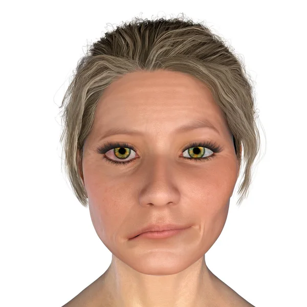 Facial Nerve Paralysis Bell Palsy Illustration Showing Female One Sided — Stock Photo, Image