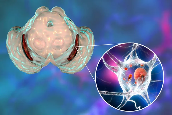 帕金森氏症中的黑质 即中脑的基底神经节 3D图像显示其体积减小 黑质包裹体中的神经元包含的Levy体减少 — 图库照片