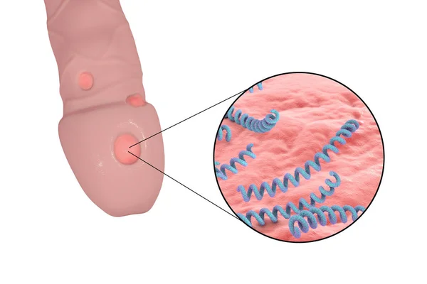 Syphilitic Ulcus Ulcus Durum Close Weergave Van Syfilis Bacteriën Treponema — Stockfoto