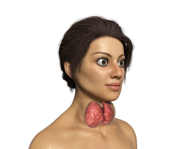 Гипертиреоз Иллюстрация Показывающая Увеличенную Щитовидную Железу Экзофтальм Выпуклые Глаза Женщины — стоковое фото
