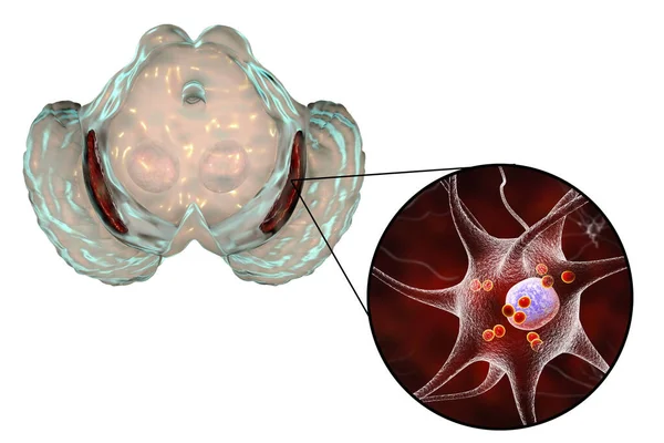 帕金森氏症中的黑质 即中脑的基底神经节 3D图像显示其体积减小 黑质包裹体中的神经元包含的Levy体减少 — 图库照片