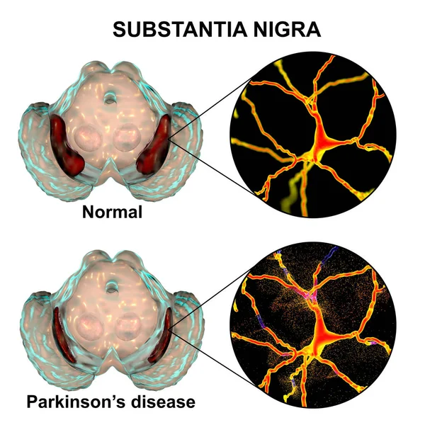 正常和帕金森病中的黑质 3D图像显示其体积减少 黑质体中的多巴胺能神经元有退化现象 — 图库照片