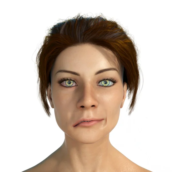 Facial Nerve Paralysis Bell Palsy Illustration Showing Female One Sided — Stock Photo, Image