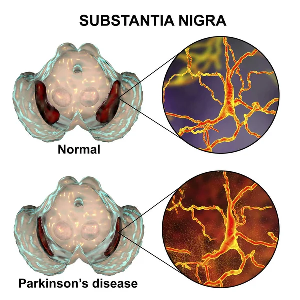 Norm Parkinson Hastalıklarında Boyutlu Illüstrasyon Hacminin Azaldığını Gösteriyor Pars Compacta — Stok fotoğraf