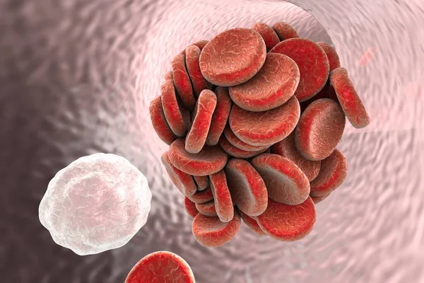Thromboembol Dans Les Vaisseaux Sanguins Formation Caillots Globules Rouges Globules — Photo