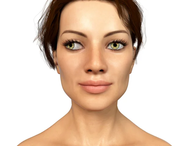 Strabismus Illustration Showing Exotropia Type Eye Deviation Eye Turns Outward — Stock Photo, Image