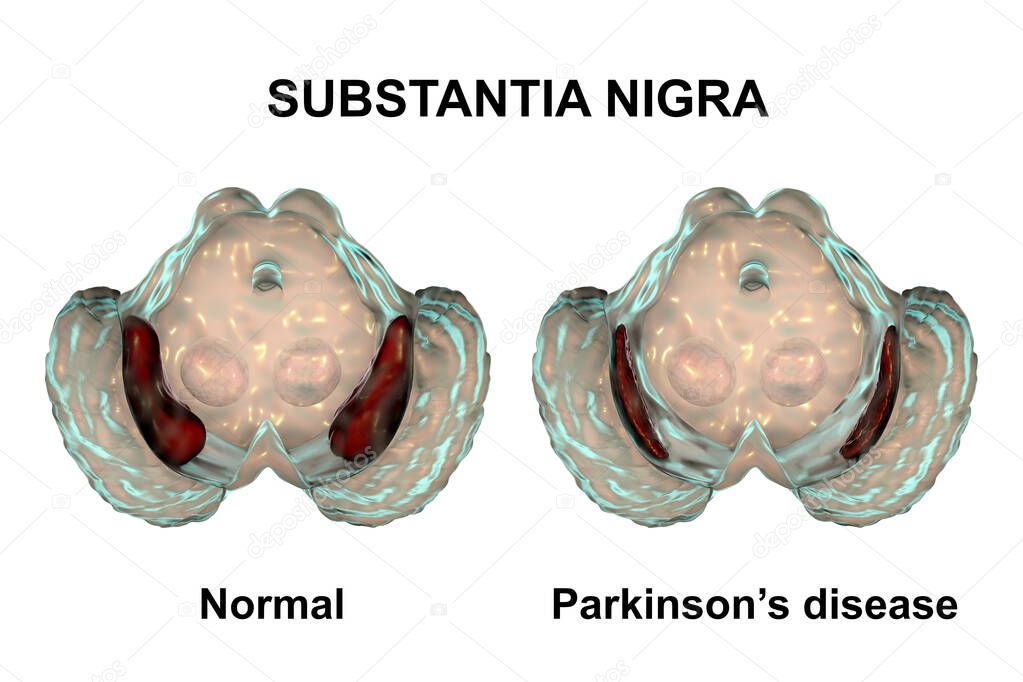 Substantia nigra in norm and in Parkinson's disease, 3D illustration showing decrease of its volume. There is degeneration of dopaminergic neurons in the pars compacta of the substantia nigra