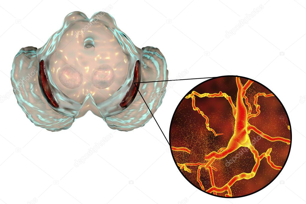 Substantia nigra, a basal banglia of the midbrain, in Parkinson's disease, 3D illustration showing decrease of its volume and degeneration of dopaminergic neurons in the pars compacta of the substantia nigra