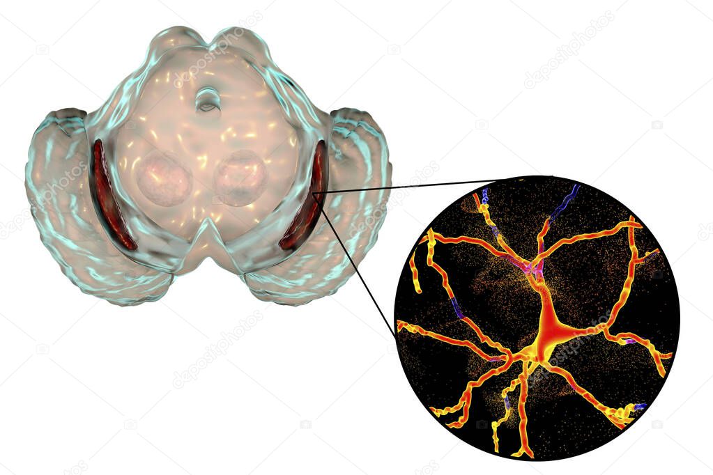 Black substance, basal banglia of the midbrain, in Parkinson's disease, 3D illustration showing decrease of its volume and degeneration of dopaminergic neurons in the pars compacta of the black substance