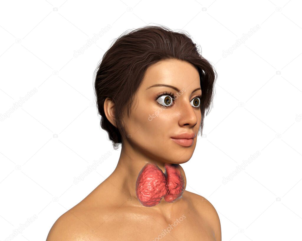 Hyperthyroidism. 3D illustration showing enlarged thyroid gland and exophthalmos (bulging eyes) in a female with Graves' disease, also known as toxic diffuse goiter