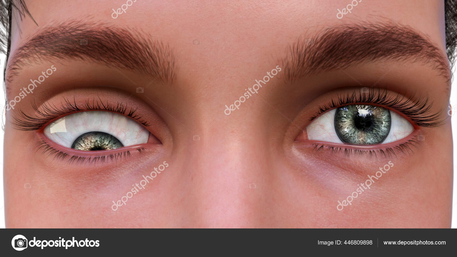 Strabismus Causes and Treatment in Turkey - Bimaristan, image size:1600x900