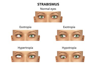 Strabismus, 3 boyutlu illüstrasyon farklı göz sapmaları gösteriyor