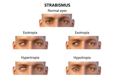 Strabismus, 3D illustration showing different types of eye deviations clipart