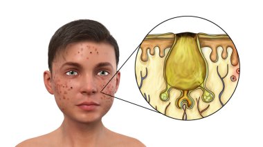 Akne vulgaris, ölü deri hücreleri ve deri tıkanmış kıl foliküllerinden çıkan yağ, genç bir çocuğun 3 boyutlu resmi ve akne siyahının yakın çekim görüntüsü ile oluşan bir cilt rahatsızlığı.