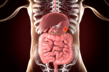 Mide kanseri, midenin içinde insan sindirim sistemi anatomisini ve tümörü gösteren 3 boyutlu illüstrasyon.