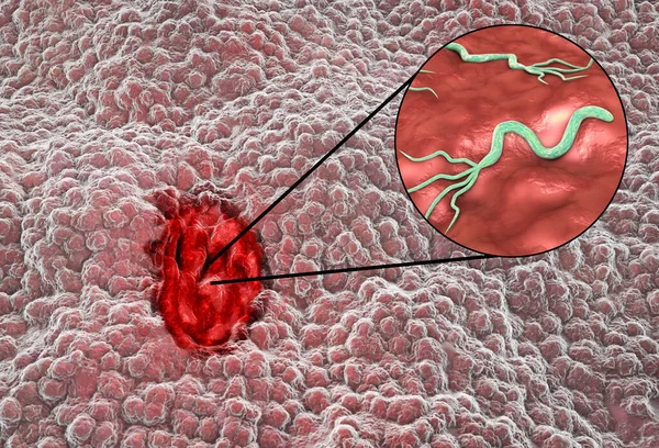 위궤양이야 소화성 궤양을 모코사 Mucosa 궤양을 일으키는 박테리아 Helicobacter Pylori — 스톡 사진