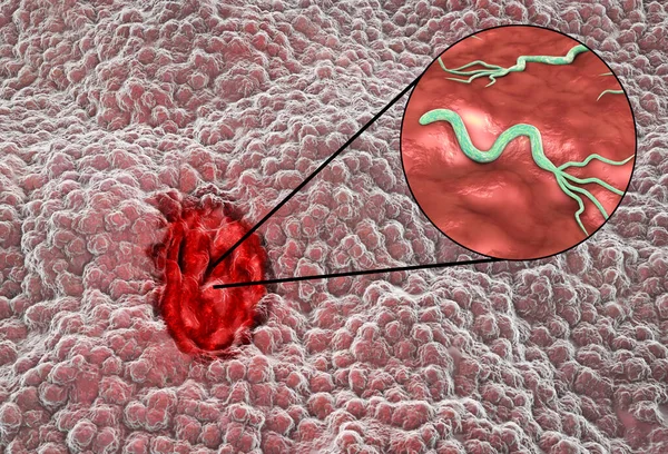 Žaludeční Vřed Mukosa Žaludku Peptickým Vředem Detailní Pohled Bakterii Helicobacter — Stock fotografie