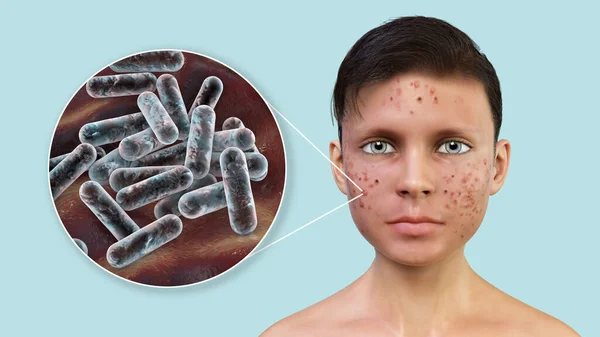 Acne Vulgaris Einem Teenager Jungen Und Nahaufnahme Des Bakteriums Cutibacterium — Stockfoto