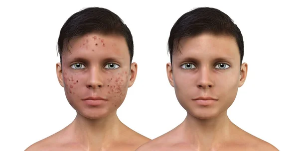 Acne Vulgaris Teenager Boy Skin Condition Occuring Dead Skin Cells — Stock Photo, Image