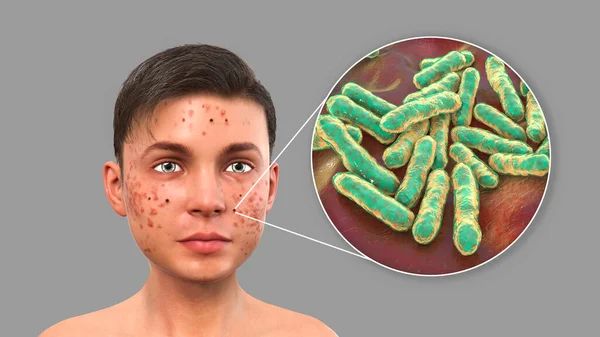 Acne Vulgaris Einem Teenager Jungen Und Nahaufnahme Des Bakteriums Cutibacterium — Stockfoto