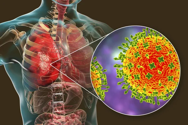 Nipah Virus Lungs Newly Emerging Bat Borne Virus Causes Acute — Stock Photo, Image