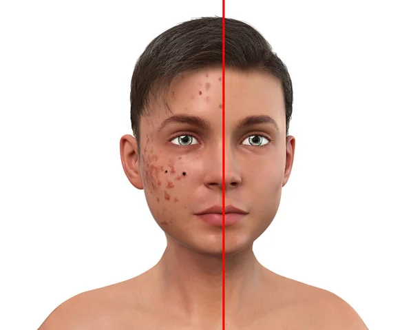 Acne Vulgaris Teenager Boy Skin Condition Occuring Dead Skin Cells — Stock Photo, Image