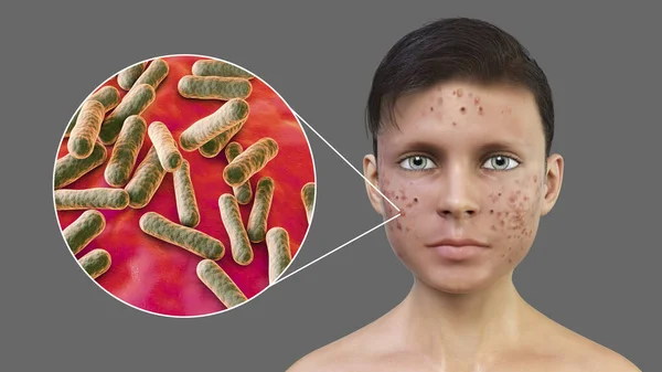 一个少年男孩的痤疮和细菌性痤疮的特写图片 形似以前的痤疮原生菌 与痤疮的发展有关 3D说明 — 图库照片