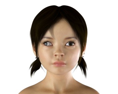 Çocuklarda strabismus, gözün dışa dönük olduğu bir tür göz sapması olan 3D exotropia (binoküler diverjans strabismus) gösterimi