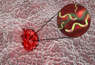 Mide ülseri. Peptik ülseri olan mide mukozası ve ülsere neden olan Helicobacter pilloriye yakından bakmak. 3B illüstrasyon