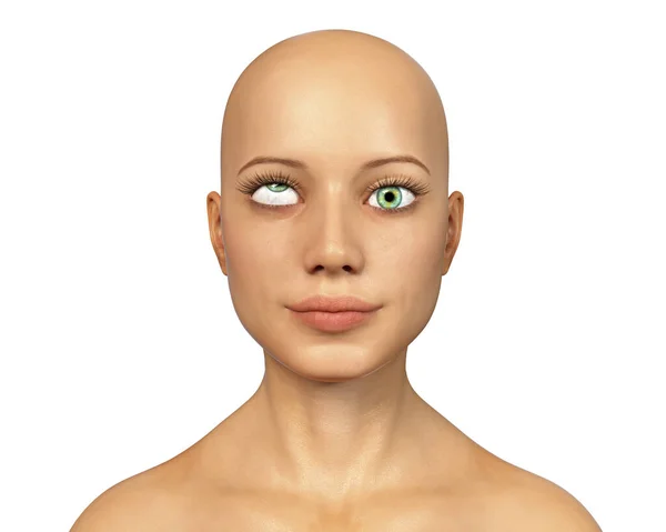 眼が上向きになるときの眼の偏差の一種である高栄養症を示す3DイラストであるStrabismus — ストック写真