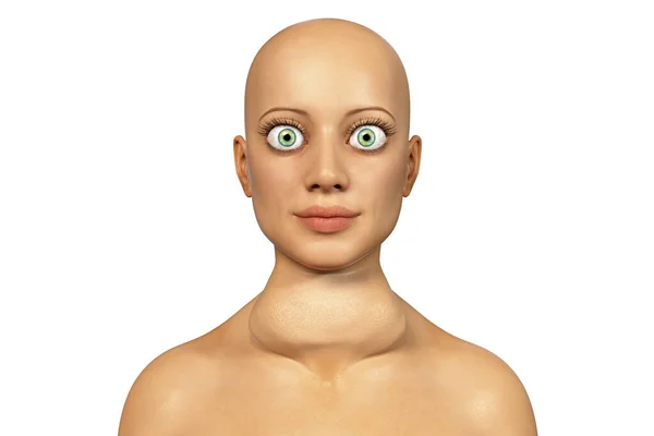 甲状腺功能亢进症3D图像显示了一个患Graves病的女性 也被称为毒性弥漫性甲状腺肿和眼部突出症 — 图库照片