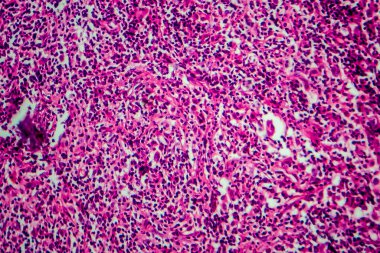 Hodgkin lenfoması, hafif mikrograf, mikroskop altında fotoğraf.