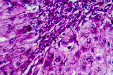 Alkolik hepatit hipopatolojisi, ışık mikrografı, mikroskop altında fotoğraf. Yüksek büyütme