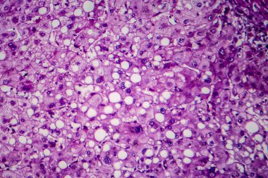 Alkolik hepatit hipopatolojisi, ışık mikrografı, mikroskop altında fotoğraf