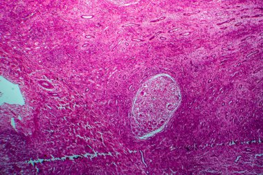 Böbrek tüberkülozu, hafif mikrograf, mikroskop altında fotoğraf.