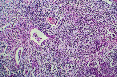 Hodgkin lenfoması, hafif mikrograf, mikroskop altında fotoğraf.