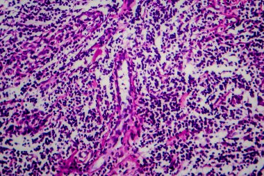 Hodgkin lenfoması, hafif mikrograf, mikroskop altında fotoğraf.