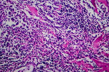 Hodgkin lenfoması, hafif mikrograf, mikroskop altında fotoğraf.