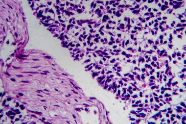 Wilms tümörü ya da nefroblastoma, ışık mikrografı, mikroskop altında fotoğraf.