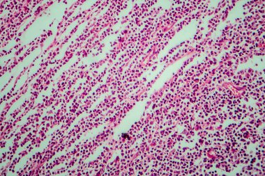 Hodgkin lenfoması, hafif mikrograf, mikroskop altında fotoğraf.